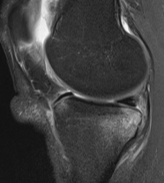 MRI ACL Rupture Bone Oedema Posterolateral Tibia